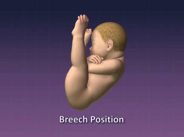 Breech baby hip dysplasia online